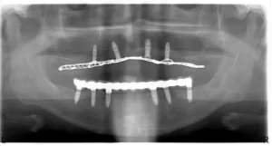 implante coronas - Implantes Dentales Almería