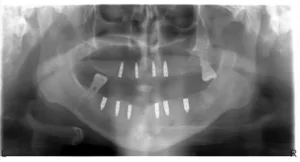 implante multiple - Implantes Dentales Almería