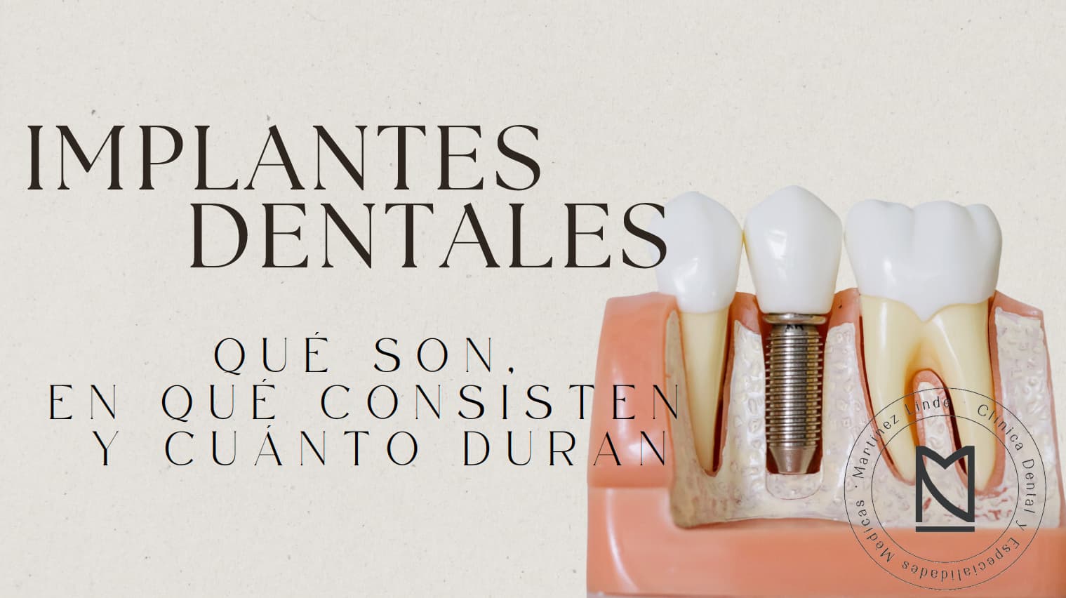 implante-dental-almeria
