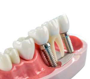 implantes almeria