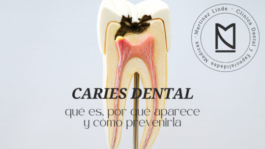 caries