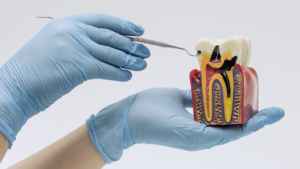 caries dentales