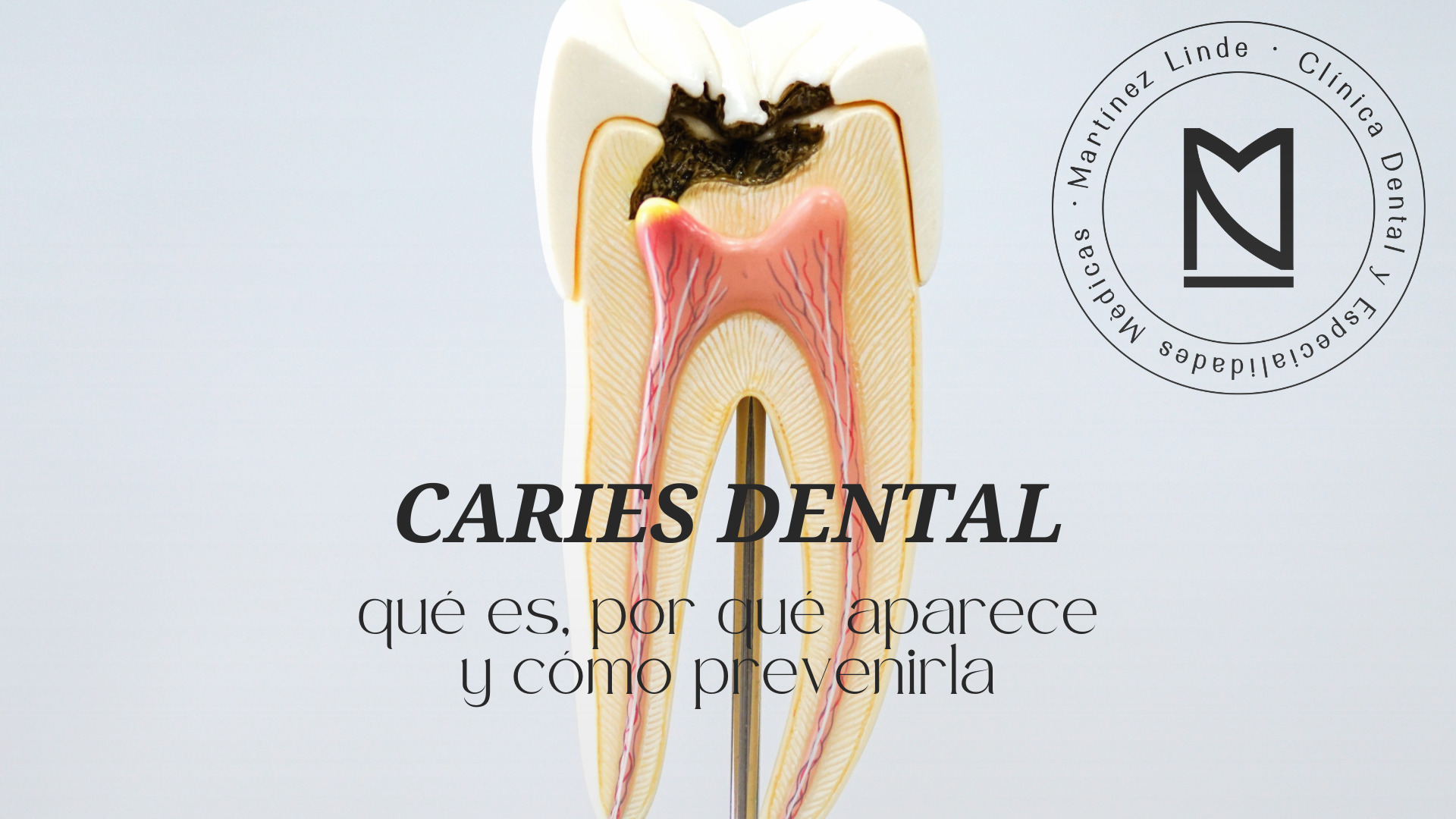 caries